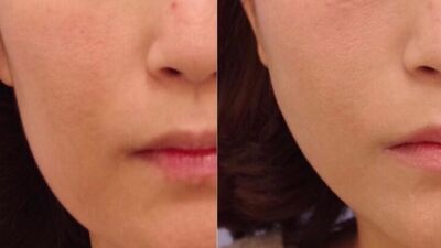 お出かけを控えがちな今だからこそ！ 最小ダウンタイム・簡単・バレずにプチ美容整形!? 人気急上昇中の美容整形5選！